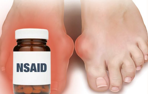 Khi nào điều trị gout bằng NSAID